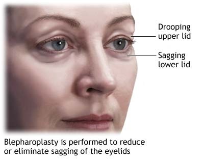 surgical reduction of the eyelids